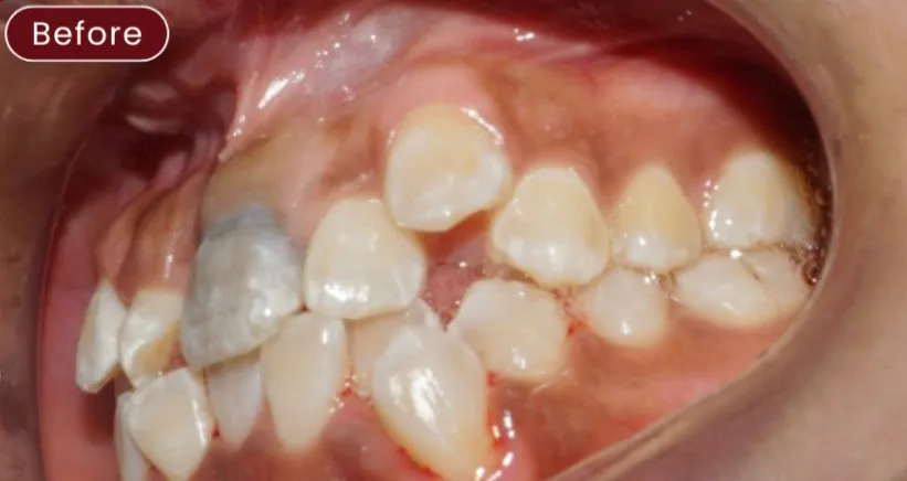Braces — example 1 before