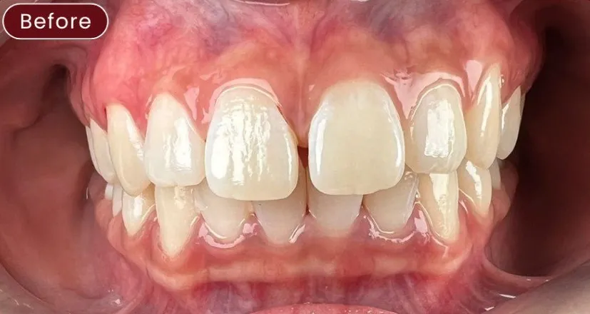 Braces — example 2 before