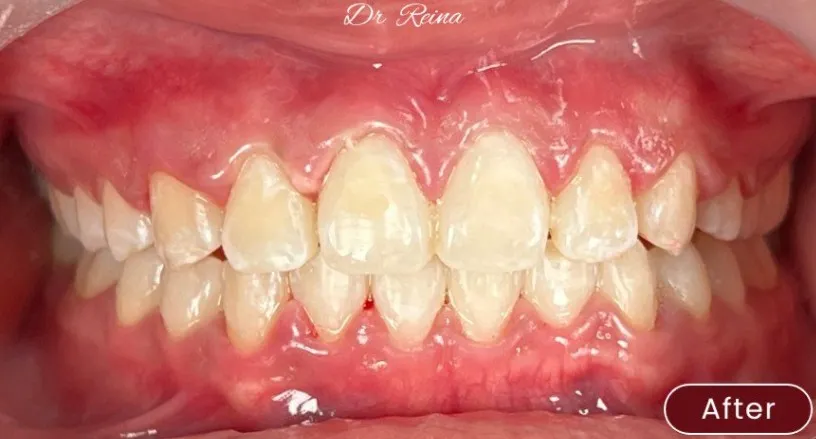 Braces — example 3 after