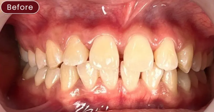 Braces — example 3 before