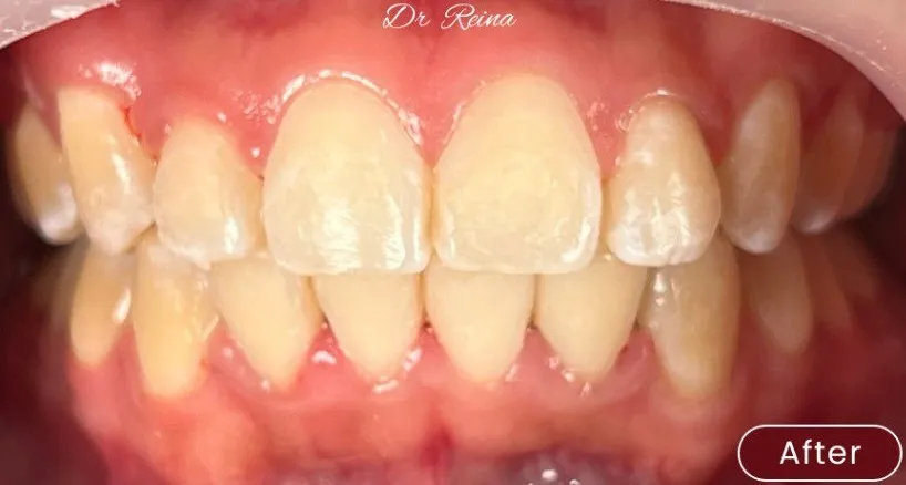 Braces — example 4 after