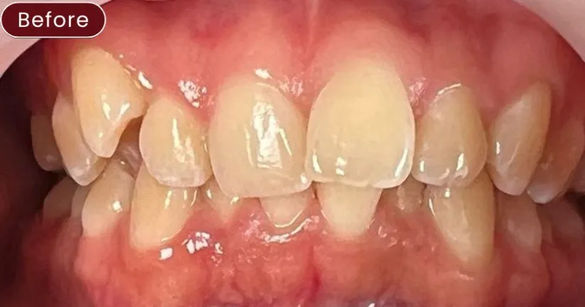 Braces — example 4 before