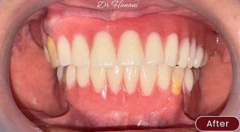 Dentures — example 1 after