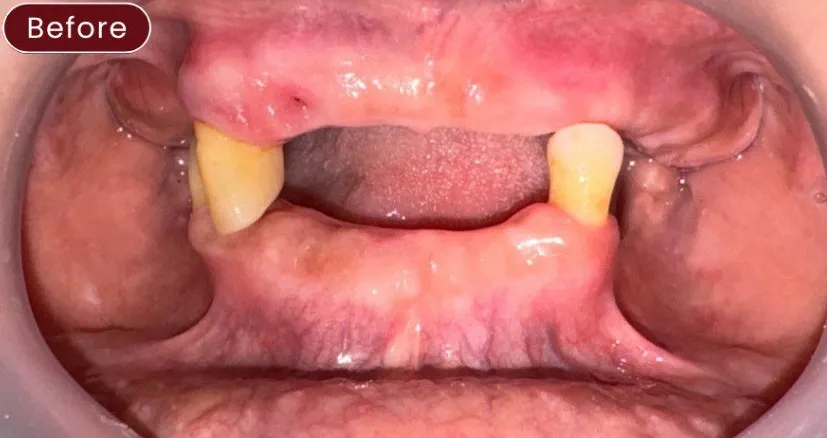 Dentures — example 1 before