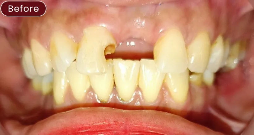 Filling — example 1 before
