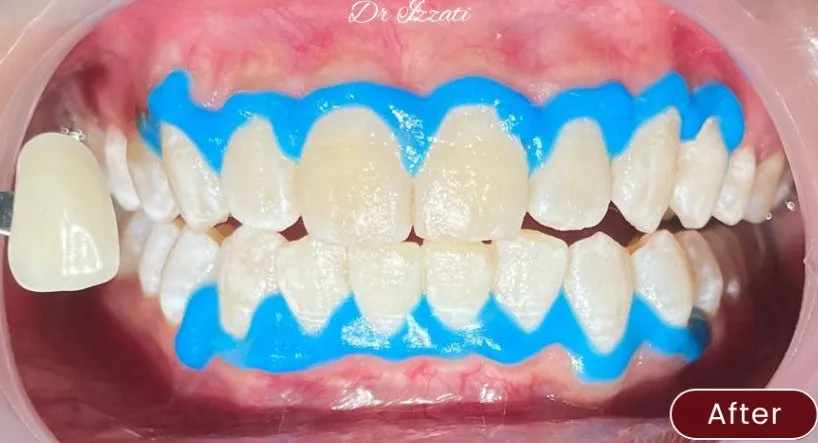 Whitening — example 1 after