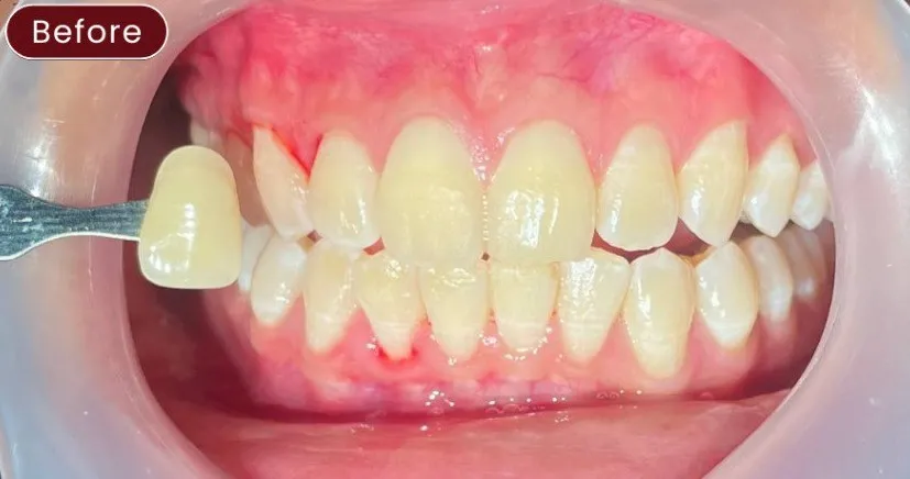 Whitening — example 1 before