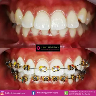 Dr Feeliz braces treatment photograph
