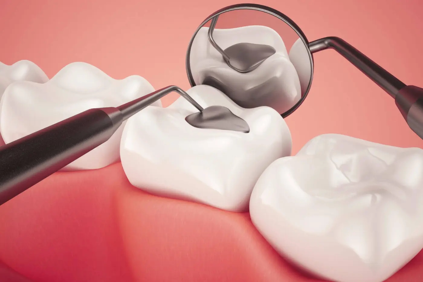 Dental filling (tampalan gigi) at Dr Feeliz