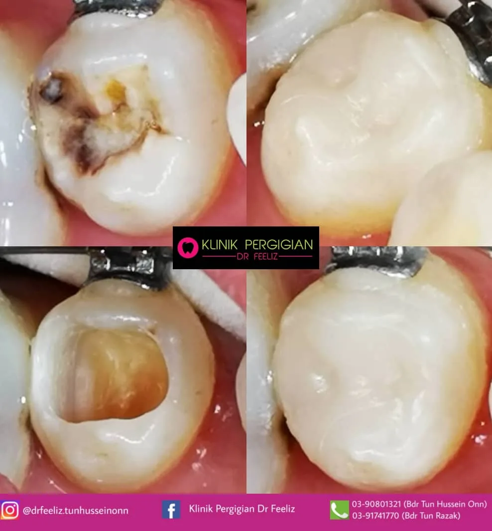 Dental filling (tampalan gigi) at Dr Feeliz