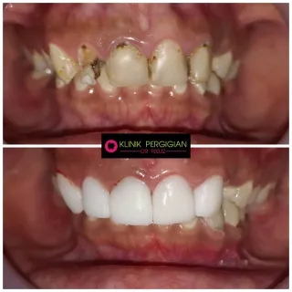 Dr Feeliz veneers treatment photograph