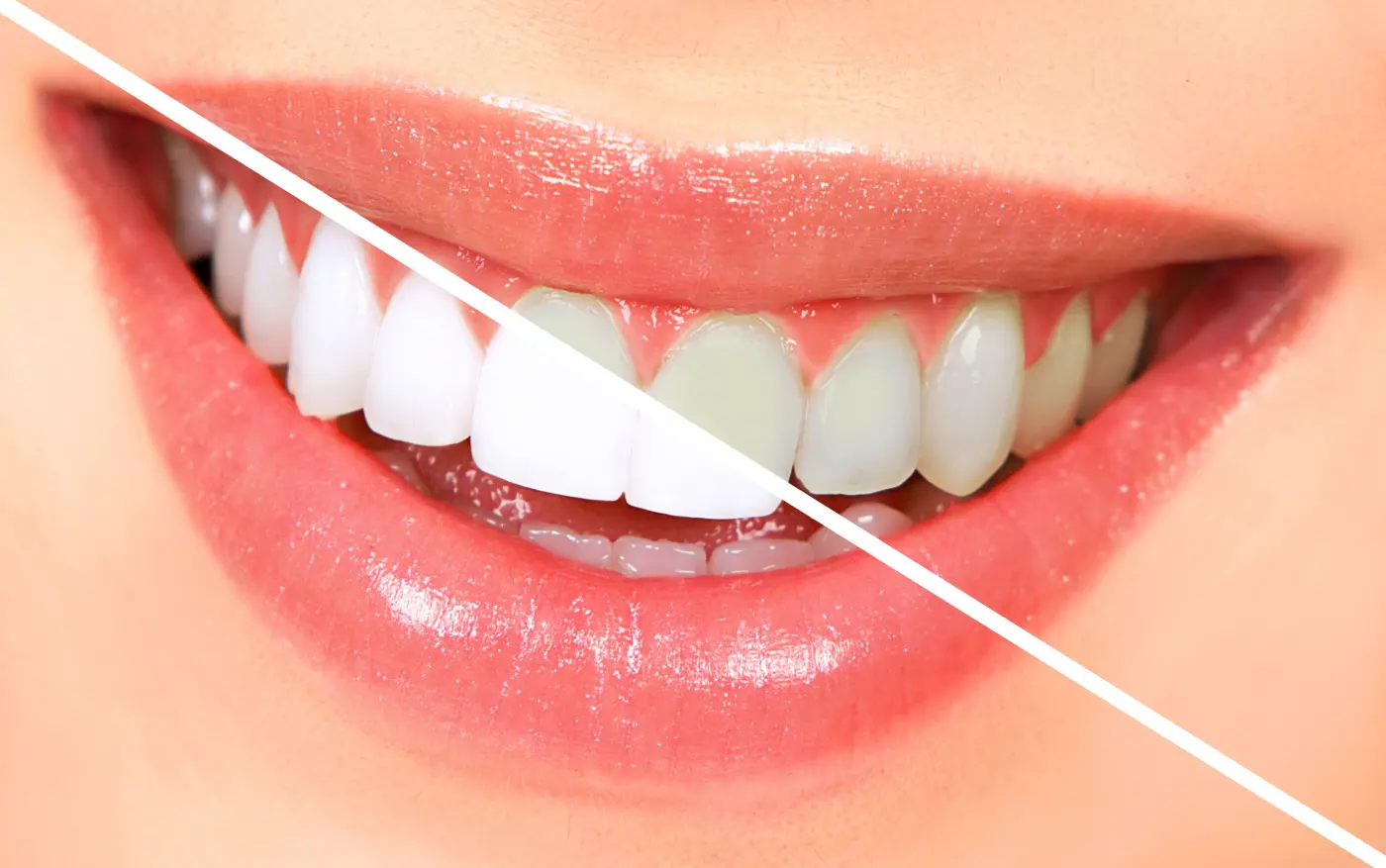 Teeth whitening (pemutihan gigi) at Dr Feeliz